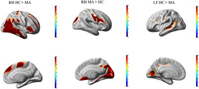 Whole brain surface-based morphometry and tract-based spatial statistics in migraine with aura patients: difference between pure visual and complex auras